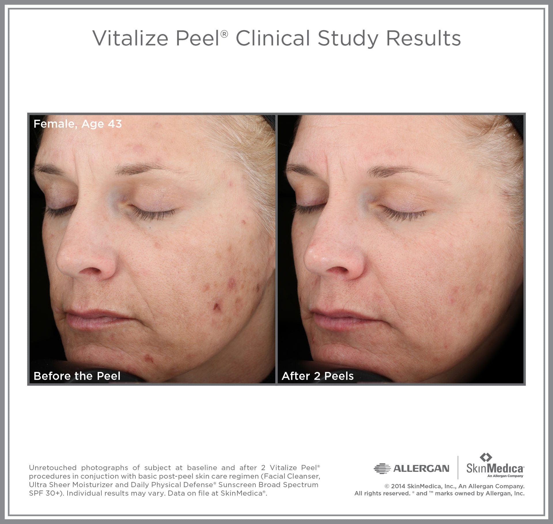 SkinMedica Vitalize Peel: Before and After Photos