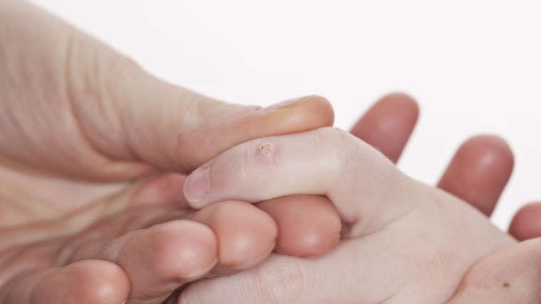 Warts Facts & Treatment