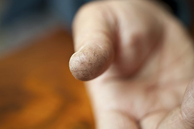 Splitting Fingertips Skin Fissures