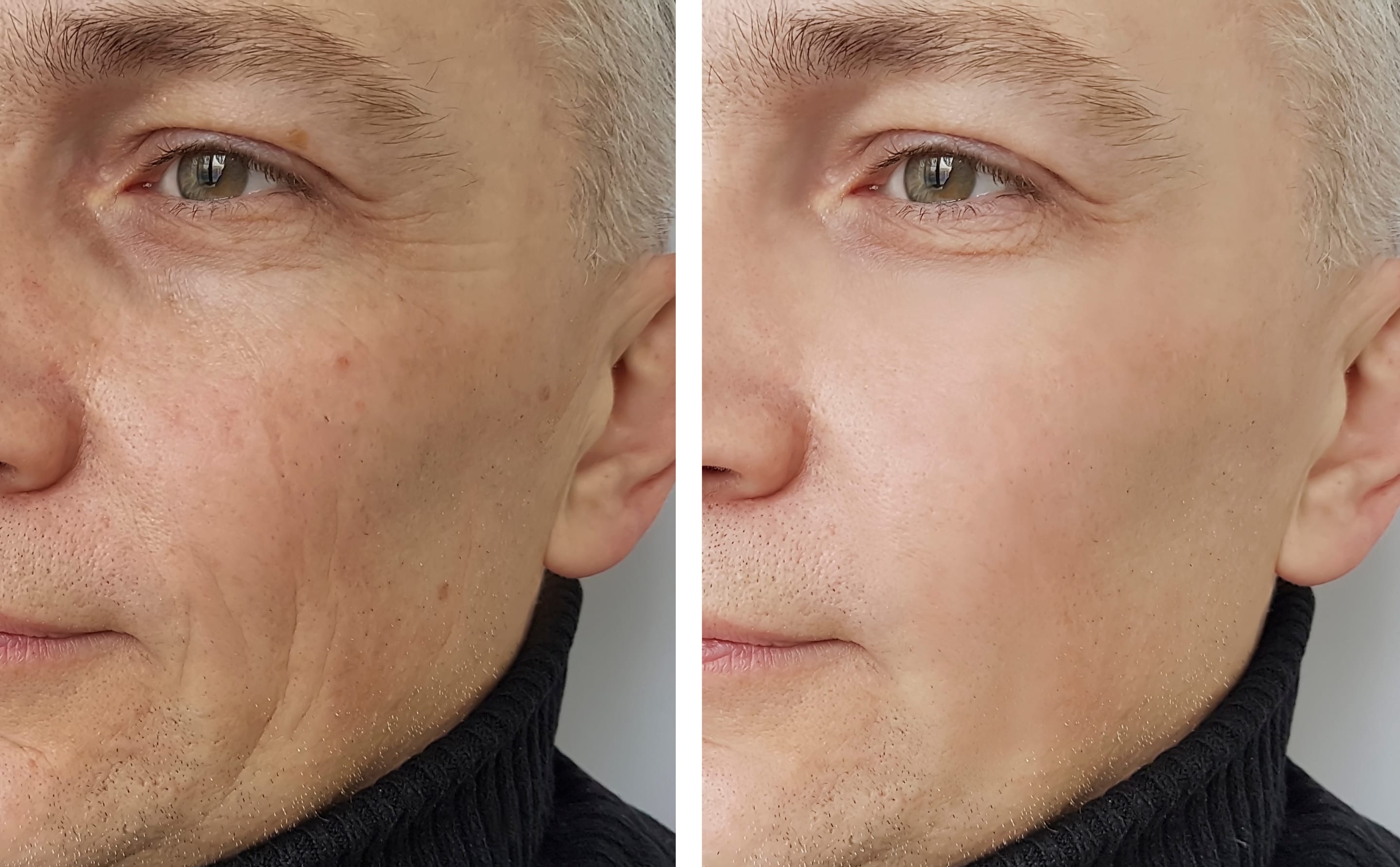 Juvederm Fillers Before and After