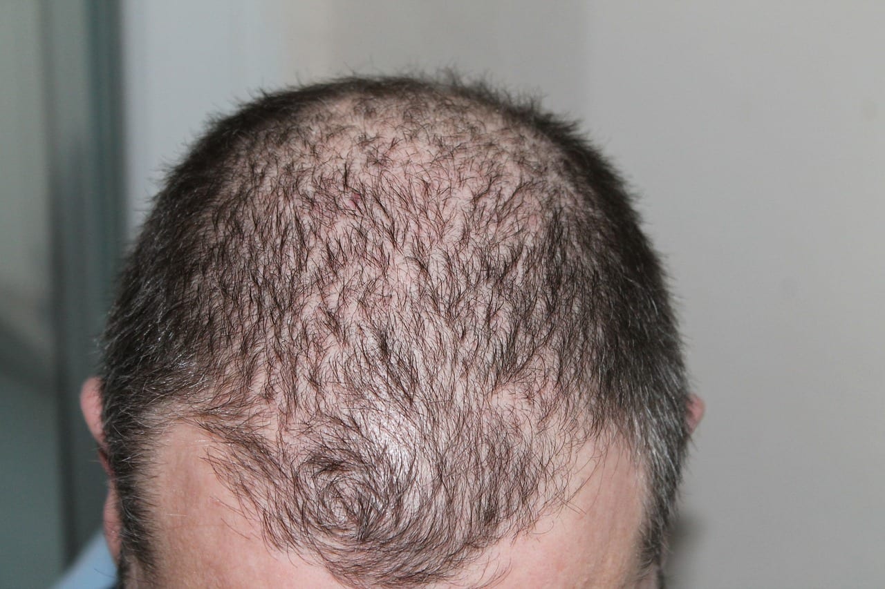 Significant Hair Loss and Thinning | Advanced Derm of the Midlands
