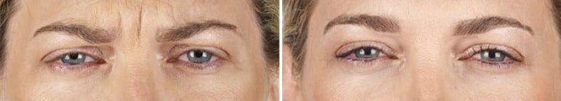 Xeomin before and after
