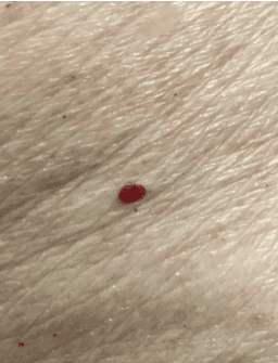 Cherry Angioma