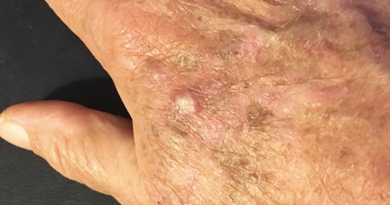 Actinic Keratosis Treatment I Advanced Dermatology Of Midlands