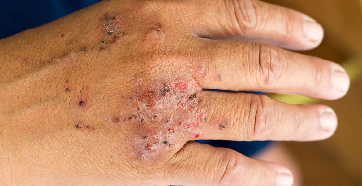 Allergic Contact Dermatitis and Patch Testing