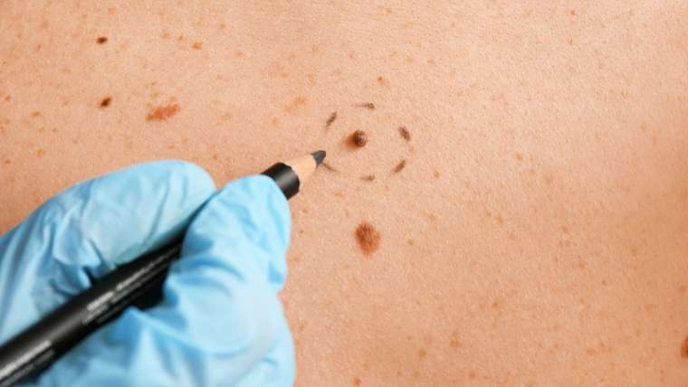 What to Know About Mole Removal