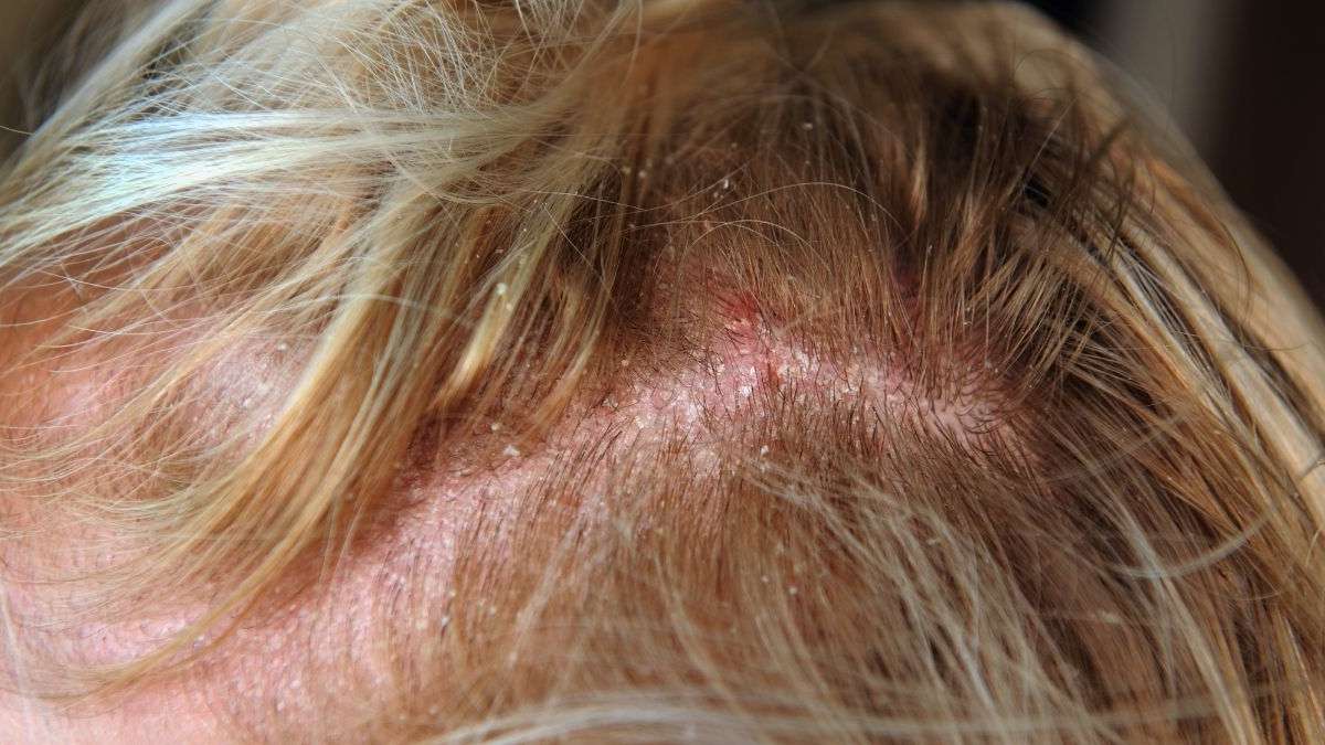 Scalp Irritation Nhs Dandruff Symptoms Nhs QNANCK