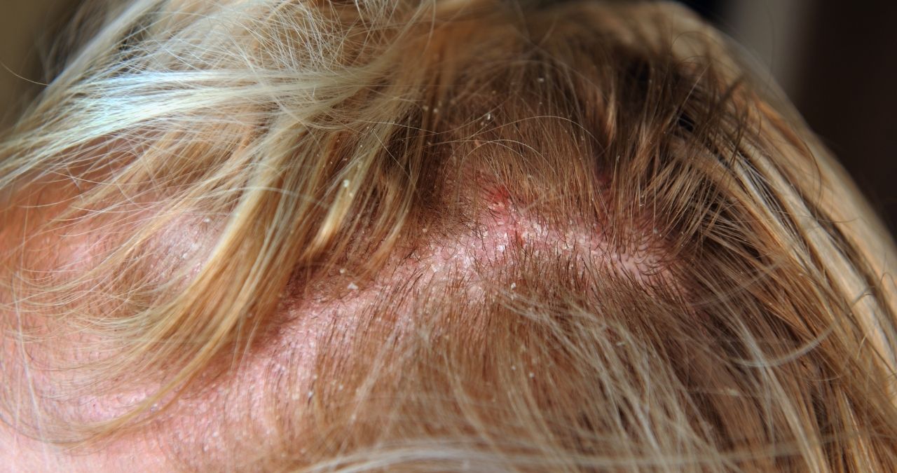 Seborrheic Dermatitis Of Scalp Icd 10 ELLHU Seborrheic Dermatitis Of Scalp Icd 10 ELLHU