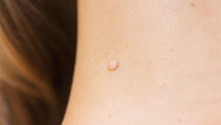 Skin Tags (Acrochordons): Treatment & Causes