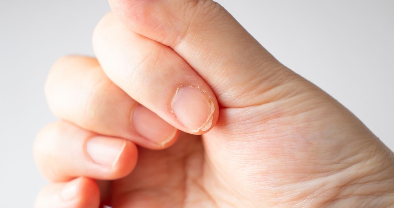 Nail Brittleness | Advanced Dermatology of the Midlands | Cracked Nails