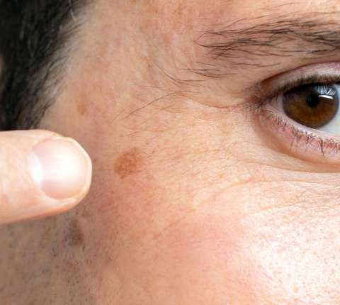 Common Dark Spots on the Face