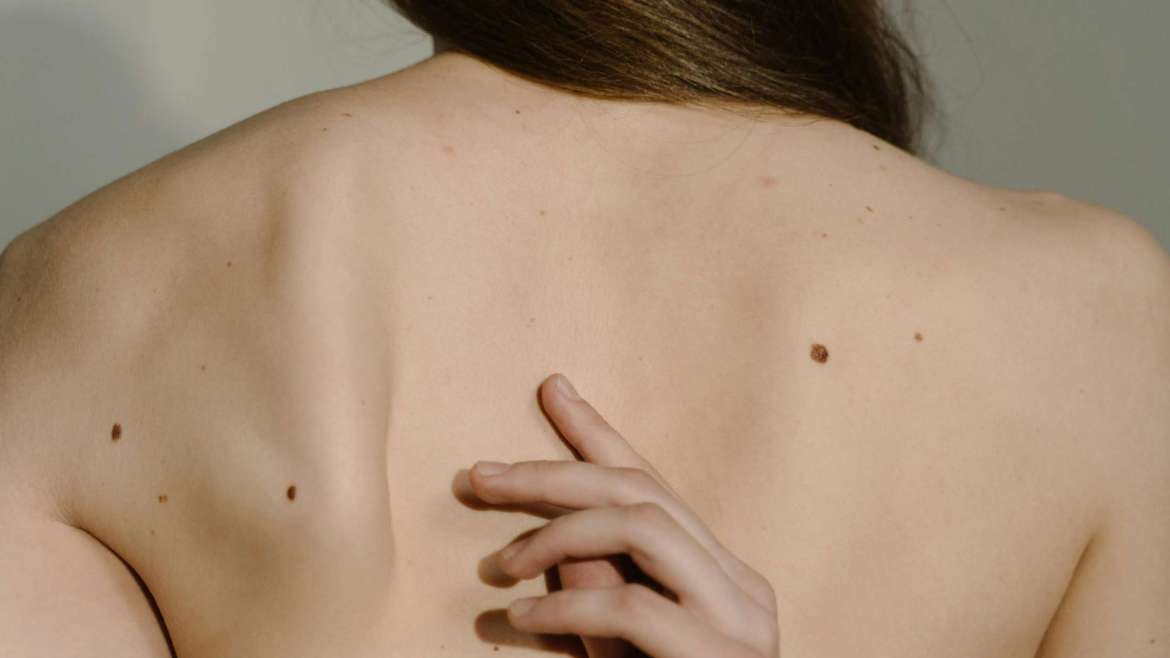 Basal Cell Carcinoma